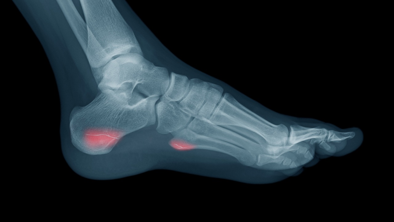 stress fracture
